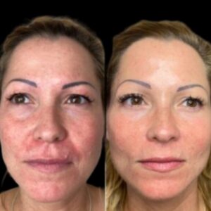 Profhilo Treatments in Dubai: Can They Help with Fine Lines and Wrinkles