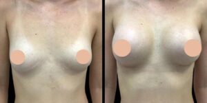 Breast Augmentation in Dubai: The Role of Personalized Consultations in Achieving Perfect Results