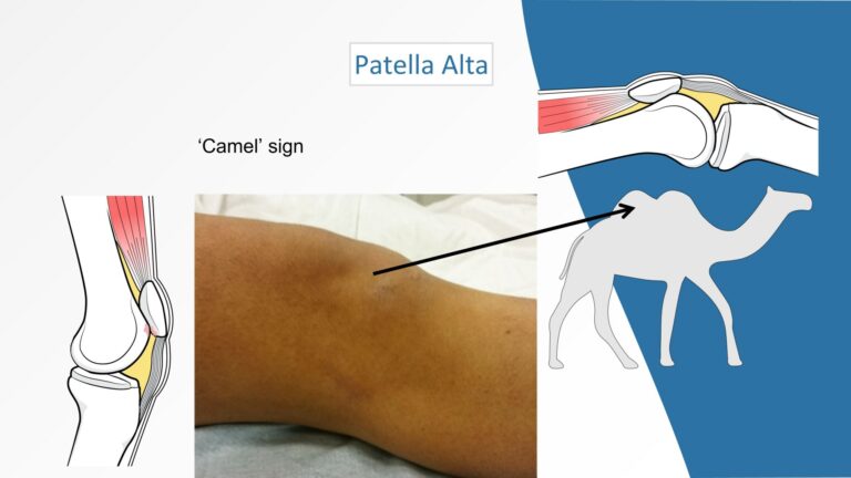 Patella Alta