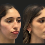 How to Find the Best Doctors in Dubai for Fat Transfer to the Face