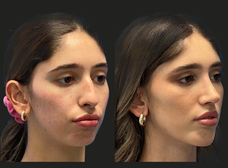 How to Find the Best Doctors in Dubai for Fat Transfer to the Face