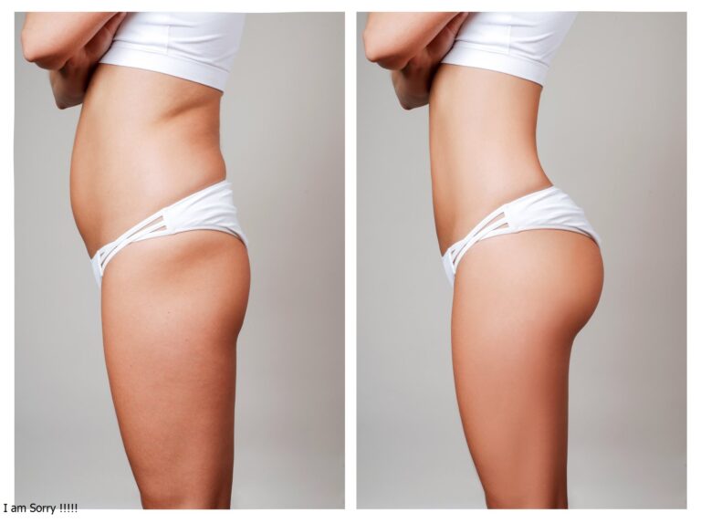 Why Choosing the Best Doctors in Dubai is Crucial for Butt Fat Transfer