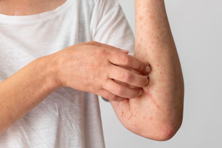 How to Treat Scabies with Ivermectin?