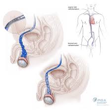 varicocele embolisation