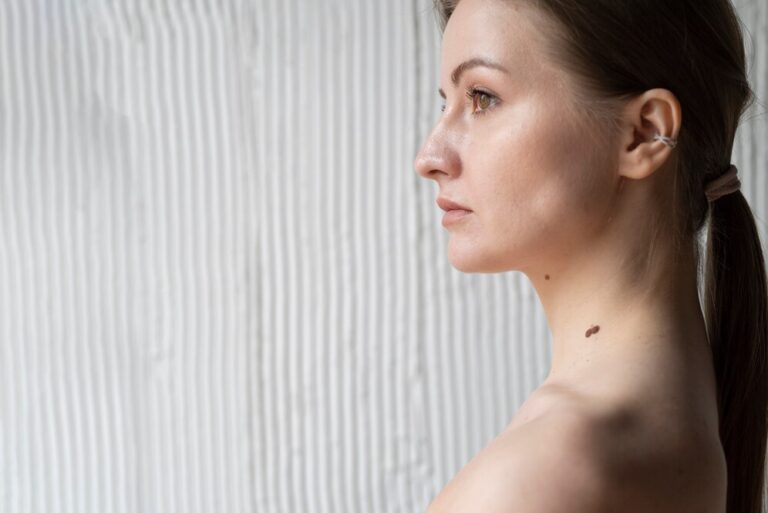 Hyperpigmentation Treatment near me