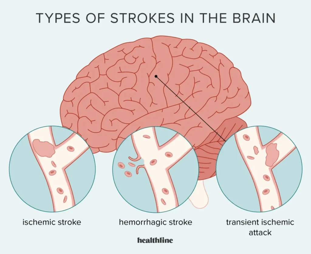 1672630-Everything-You-Need-to-Know-About-Stroke_1296x1059-1
