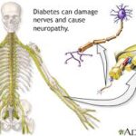 Diabetes-Related Nerve Damage