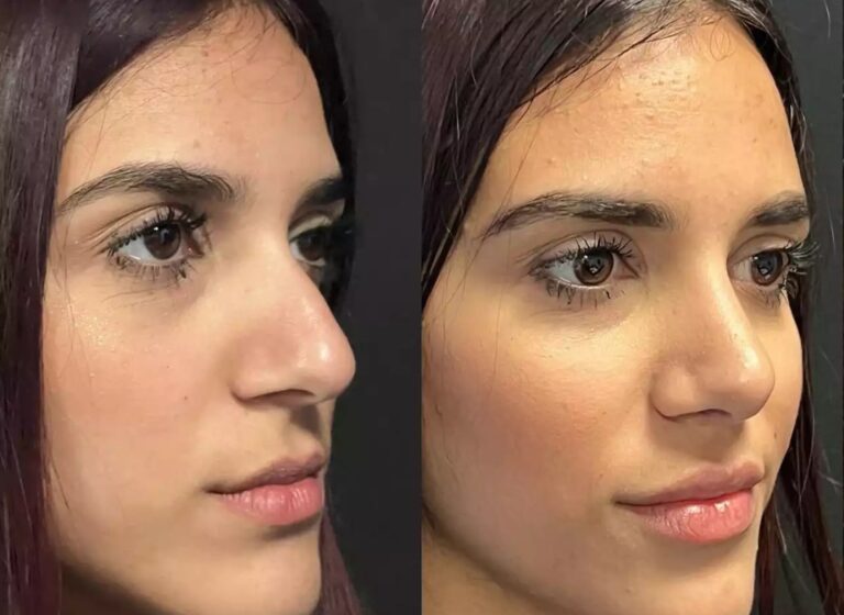 septoplasty in Dubai