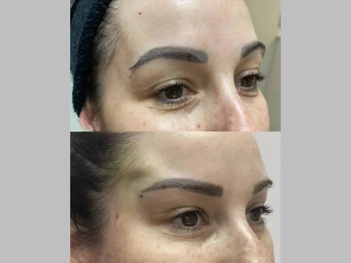How to Choose the Best Aesthetic Clinic in Dubai for Thread Lifts