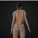 Scoliosis Surgery image