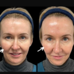 sculptra fillers in dubai