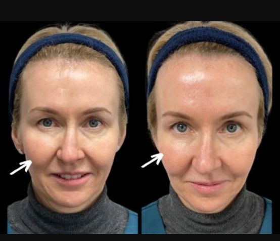 sculptra fillers in dubai