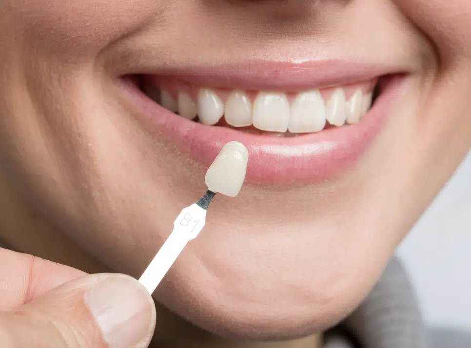 Veneers, Crowns, or Bonding