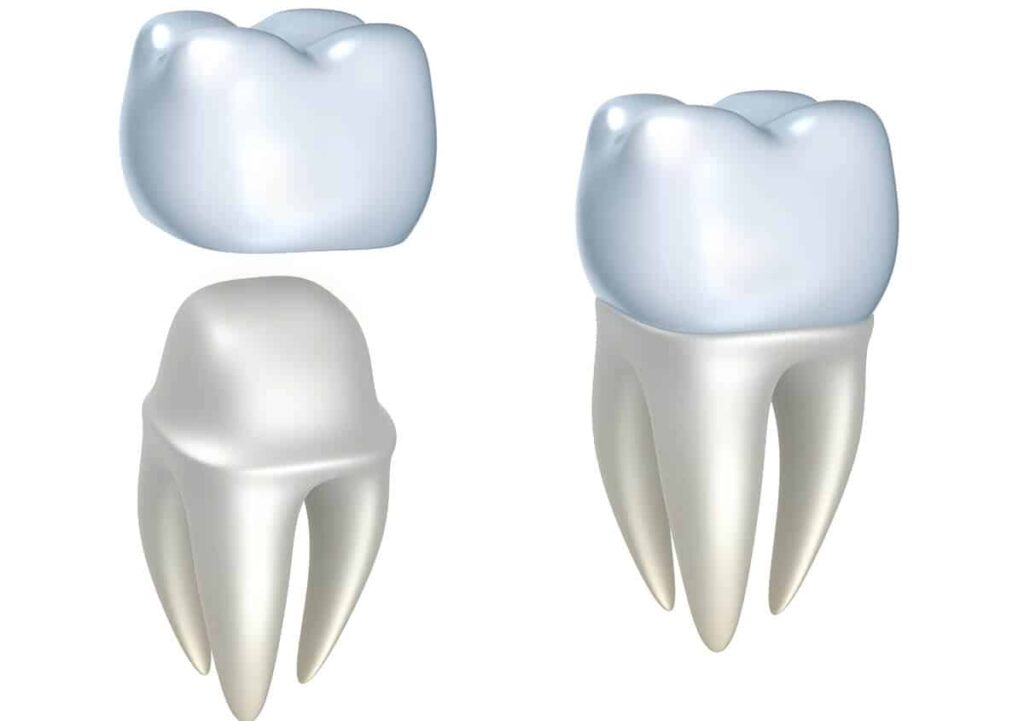 Tooth Crowns in Dubai: Types, Benefits, and Choosing the Right One for You