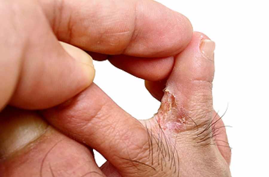 foot and eczema