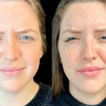 Botox in dubai