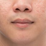 Acne Scar Treatment in Dubai