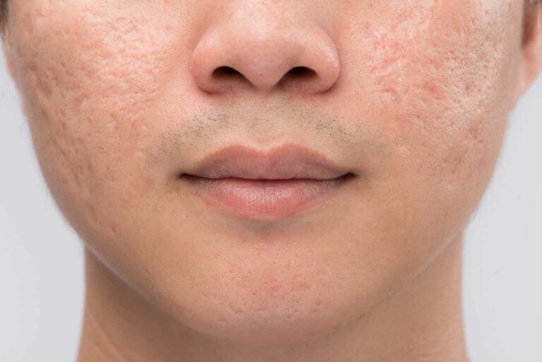 Acne Scar Treatment in Dubai
