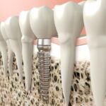 Best Dental Implants