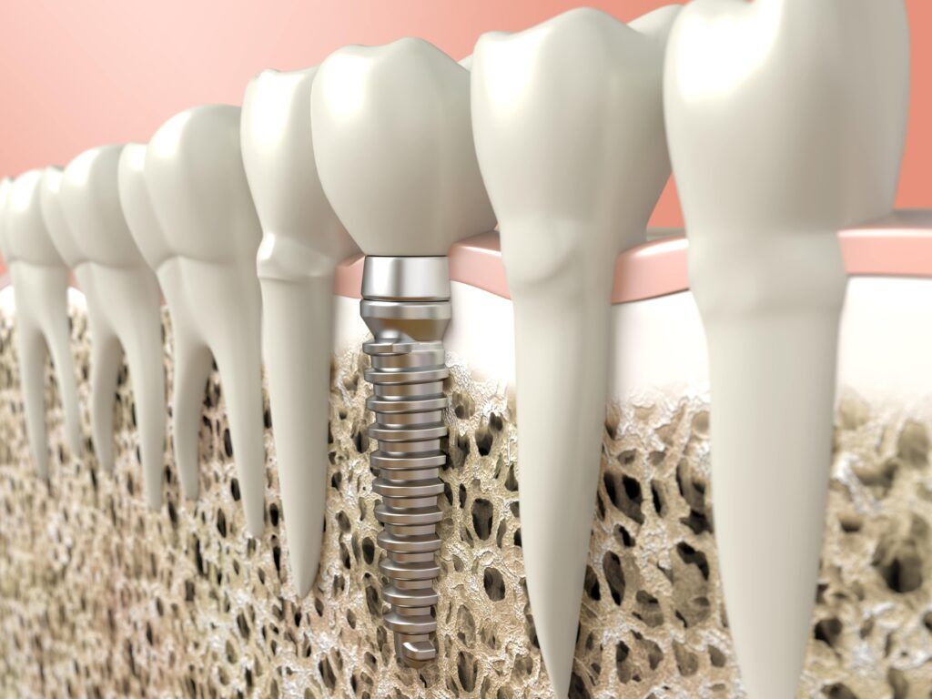 Best Dental Implants