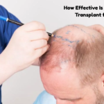 Crown hair transplant