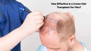 Crown hair transplant