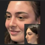best rhinoplasty surgeon in dubai