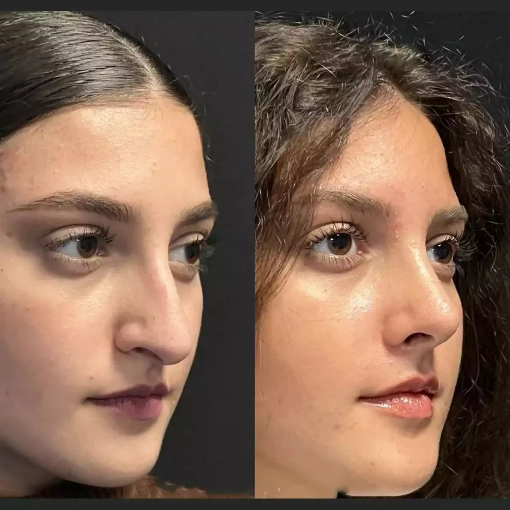 septoplasty in dubai