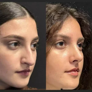 septoplasty in dubai