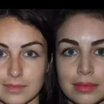 rhinoplasty in Dubai