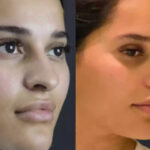 rhinoplasty in dubai