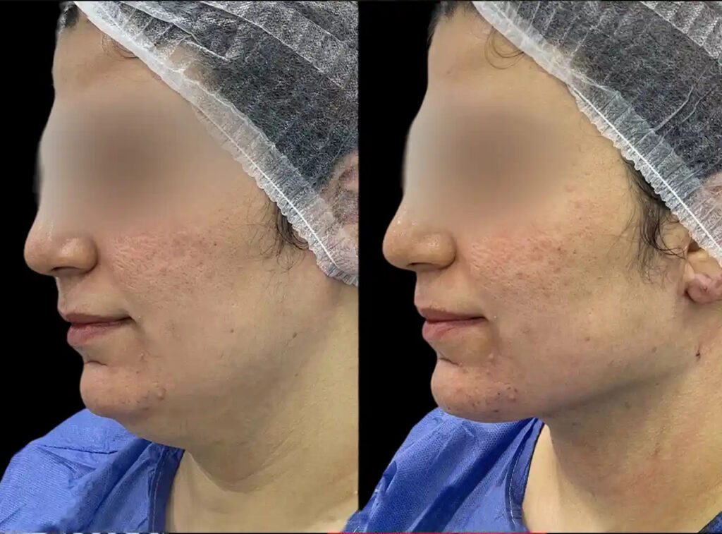 Chin Fillers in Dubai