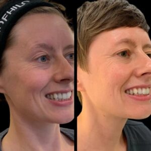 Why the Best Doctors in Dubai Recommend Profhilo for Glowing Skin