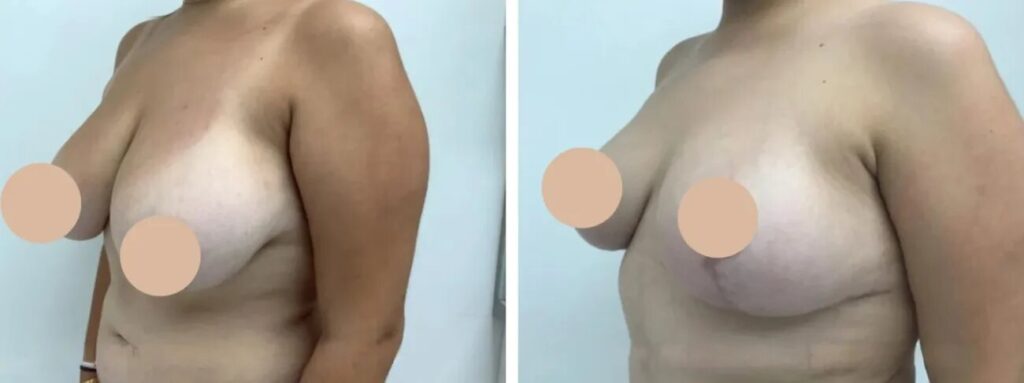 breast lift in dubai