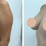 breast lift in dubai