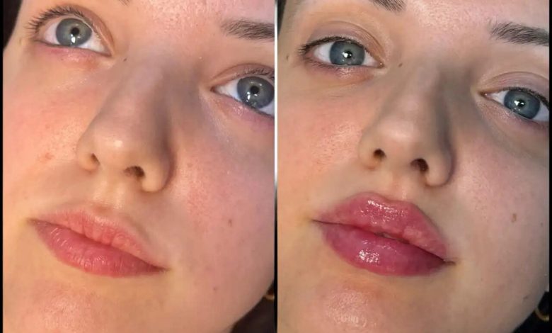 H5-lip-fillers-1-1-780x470