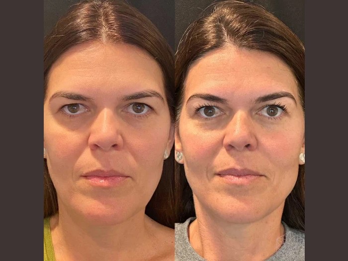 What Makes Thread Lift in Dubai Popular Among Middle-Aged Professionals