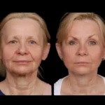 H7-Under-eye-fillers