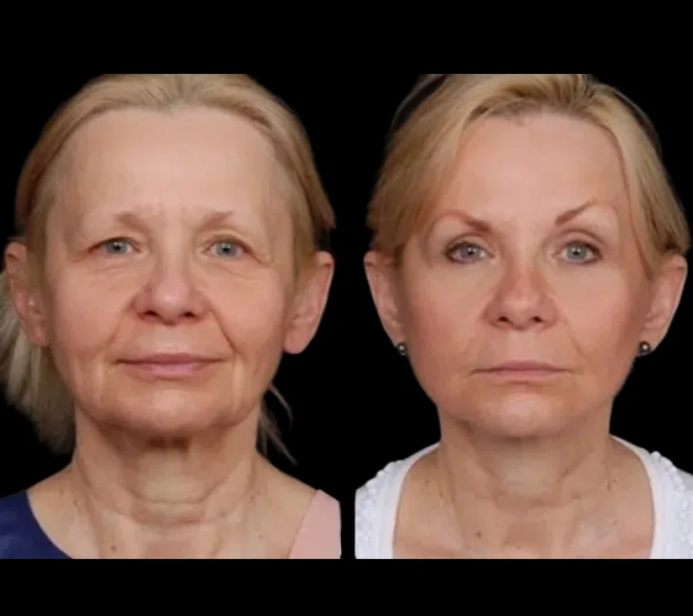 H7-Under-eye-fillers