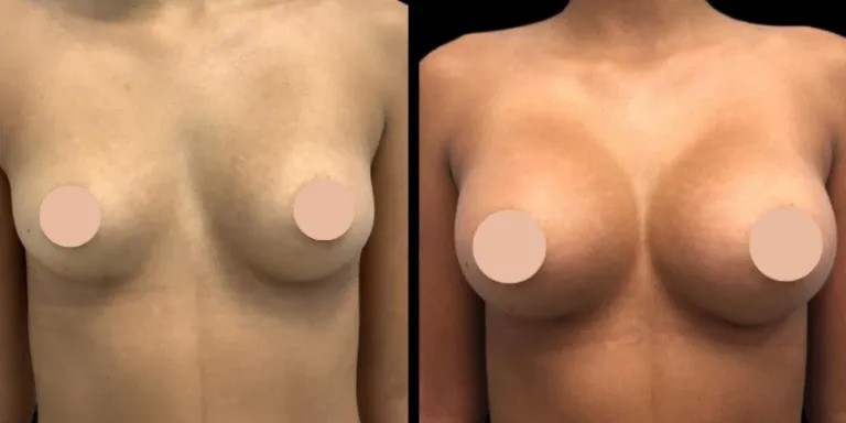 Breast Augmentation Surgery in Dubai How the Procedure Has Evolved Over the Years