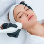 acne treatment