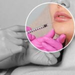 Lipfillers