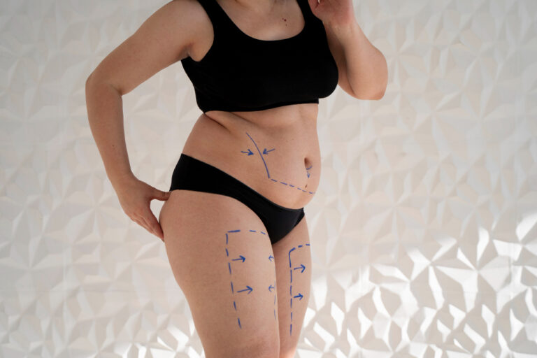 Tummy Tuck in Dubai