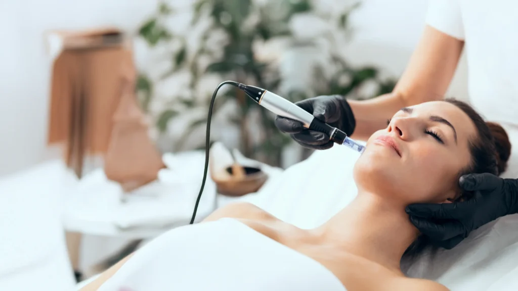 RF microneedling treatment in London