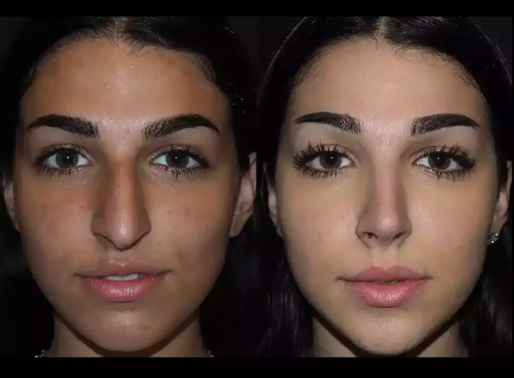 septoplasty in Dubai