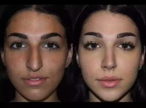 septoplasty in Dubai