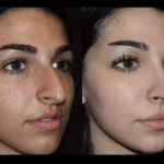 septoplasty in dubai