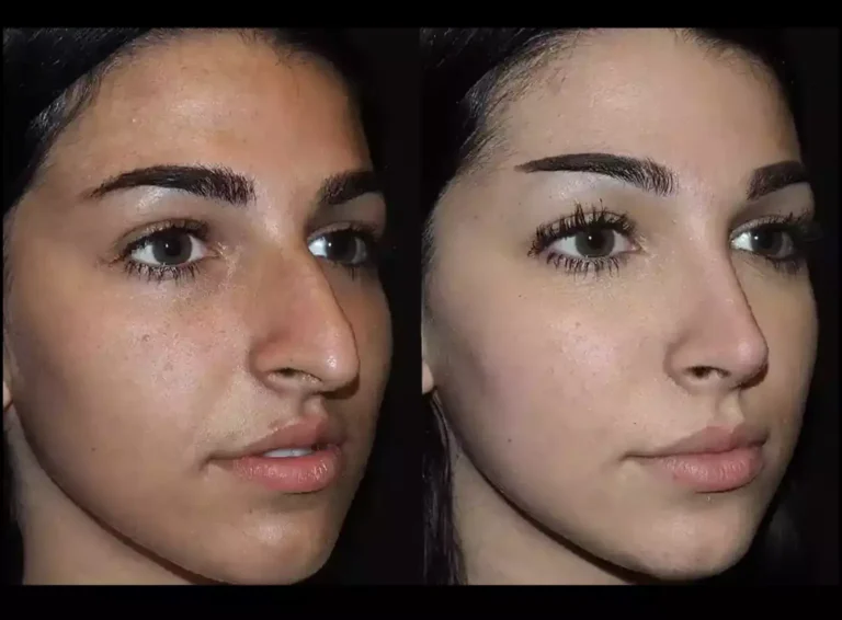 septoplasty in dubai