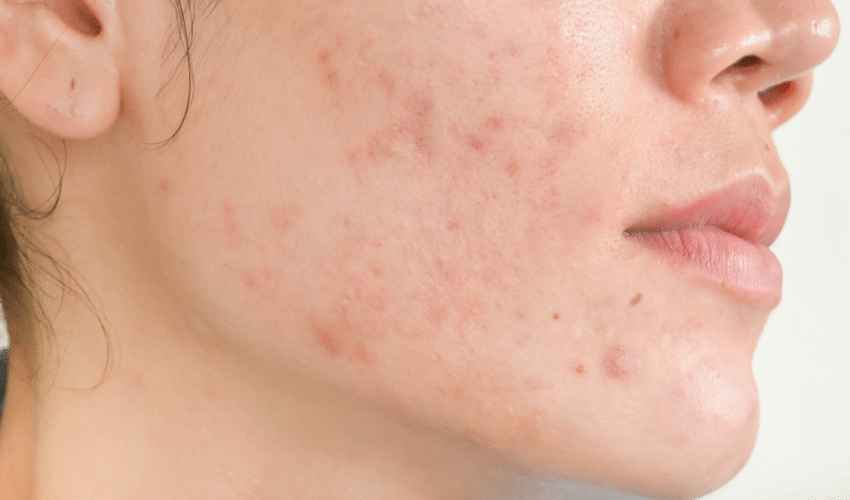 Acne Scar Treatment in Dubai
