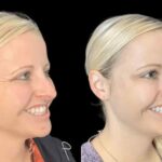 Everything You Need to Know About Botox in Jeddah: Benefits, Safety & Results
